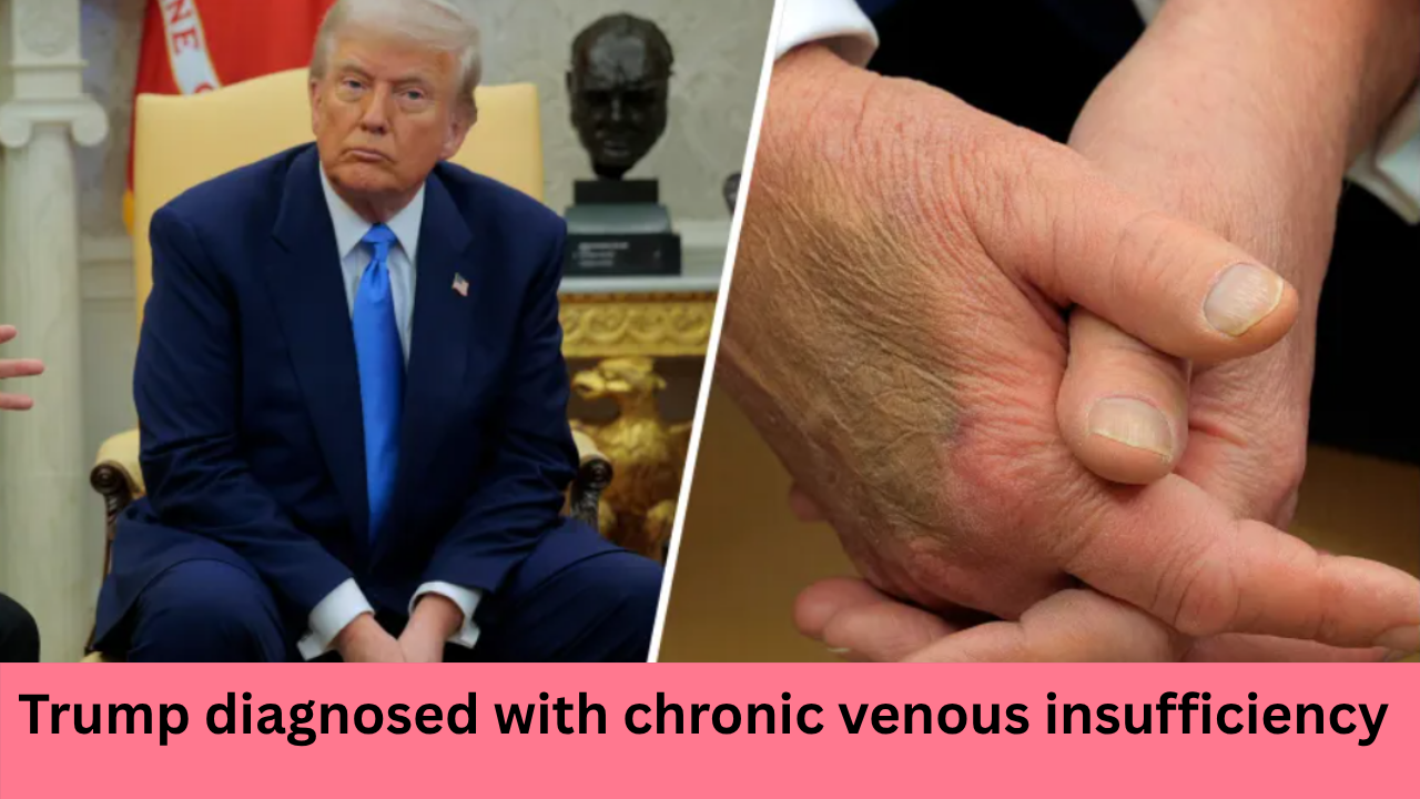 Chronic Venous Insufficiency