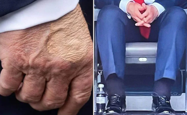 Chronic Venous Insufficiency Diagnosis: How Serious Is Trump’s Condition?