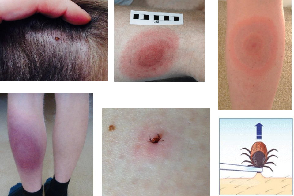 What Is Lyme Disease? Justin Timberlake’s Health Scare Explained