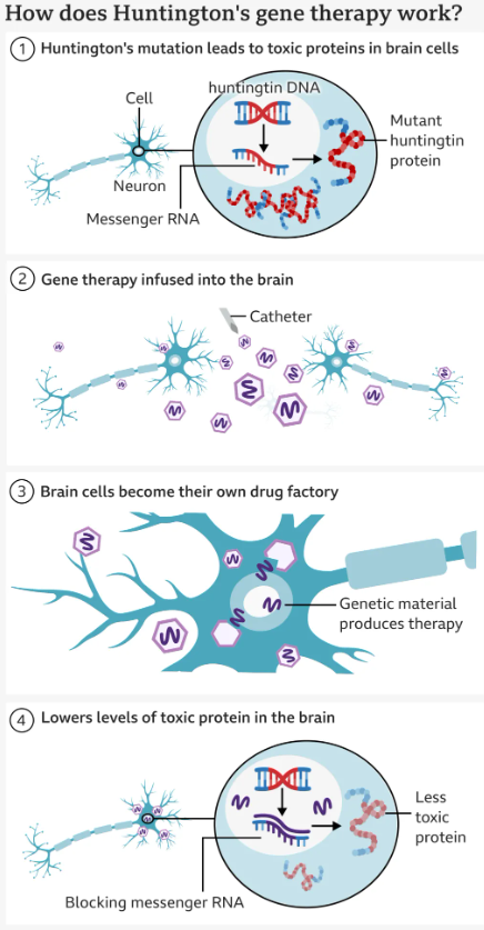 Huntington’s disease treated successfully for first time in UK
