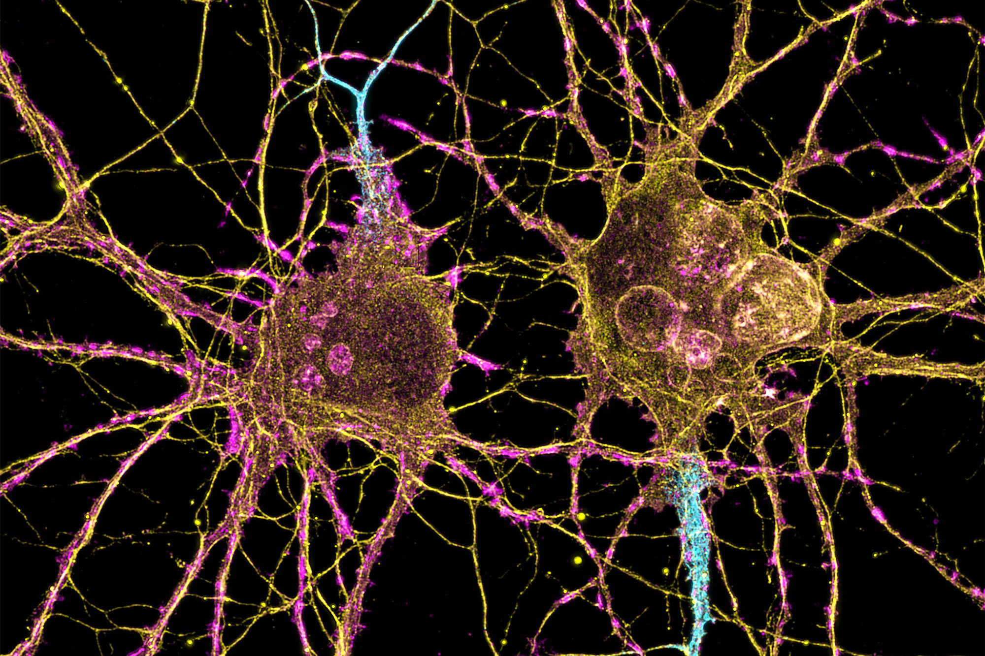 Huntington’s disease treated successfully for first time in UK